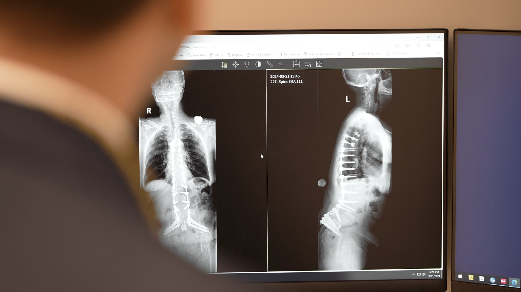Full-length standing radiographs reviewed on a diagnostic monitor